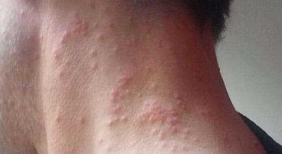 Urticaire dû aux chenilles processionnaire